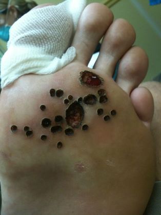 Մաշկը ոտքի վրա գտնվող warts լազերային հեռացումից հետո
